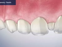 Supernumerary Teeth