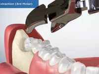 Surgical Extraction (3rd Molar)