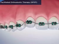 Surgically Facilitated Orthodontic Therapy (SFOT)
