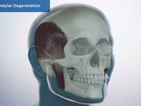TMD Condylar Degeneration
