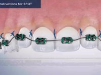 Post-Op Instructions for SFOT