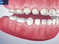 Ankyloglossia