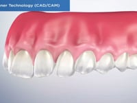 Clear Aligner Technology (CADCAM)