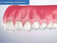 Clear Aligner Technology (Impression)