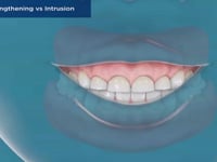 Crown Lengthening vs Intrusion