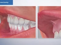 Labial Frenectomy