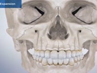 Maxillary Expansion