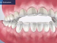 Orthodontic Extrusion