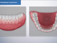 Options for Mandibular Expansion