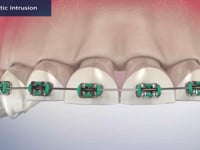 Orthodontic Intrusion