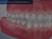 Orthodontic Home Care for Traditional Braces