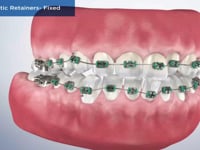 Orthodontic Retainers- Fixed