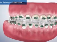 Orthodontic Retainers- Removable