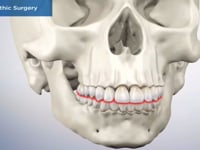 Orthognathic Surgery