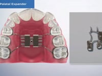 Pediatric Palatal Expander
