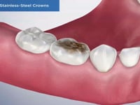 Pediatric Stainless-Steel Crowns