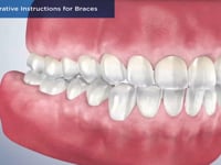 Post-Operative Instructions for Braces