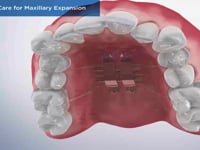 Post-Op Care for Maxillary Expansion