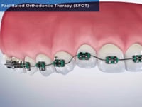 Surgically Facilitated Orthodontic Therapy (SFOT)