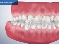 Traditional Orthodontics