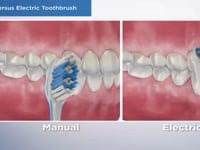 Manual versus Electric Toothbrush