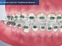 Orthodontic Home Care for Traditional Braces