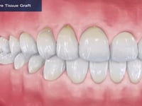 Connective Tissue Graft