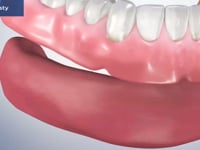 Alveoplasty