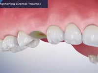 Crown Lengthening (Dental Trauma)