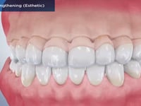 Crown Lengthening (Esthetic)