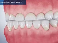 Crown Lengthening (Tooth Wear)