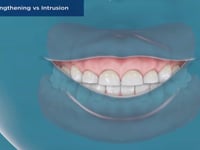 Crown Lengthening vs Intrusion