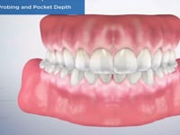 Gingival Probing and Pocket Depth