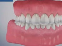 Gingival Recession