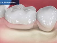 Guided-Bone Regeneration