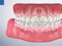 Gingivitis