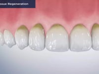 Guided-Tissue Regeneration