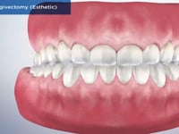 Laser Gingivectomy (Esthetic)