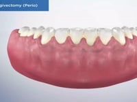 Laser Gingivectomy (Perio)