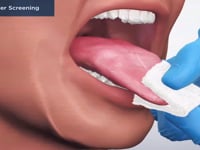 Oral Cancer Screening