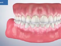 Debridement