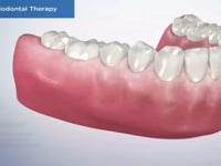 Laser Periodontal Therapy