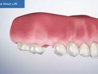 Osteotome Sinus Lift
