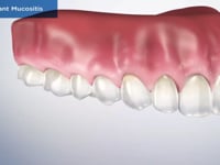 Peri-Implant Mucositis