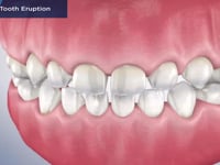 Pediatric Tooth Eruption