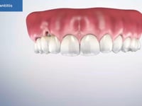 Peri-Implantitis