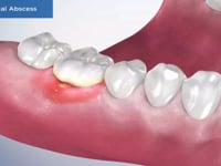 Periodontal Abscess
