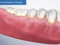 Periodontal Maintenance Therapy