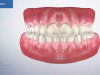 Periodontitis