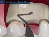Post-Operative Instructions for a Bone Graft